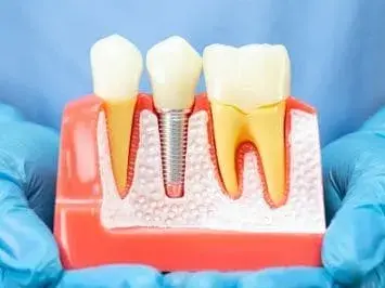 Implantes Dentários